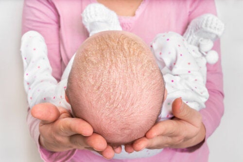 Seboreisk eksem hos spedbarn