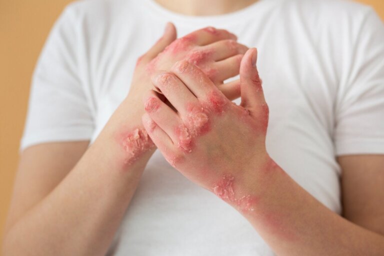 10 hudsykdommer assosiert med autoimmune lidelser